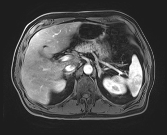 Cecal mass causing appendicitis (Radiopaedia 59207-66532 H 44).jpg