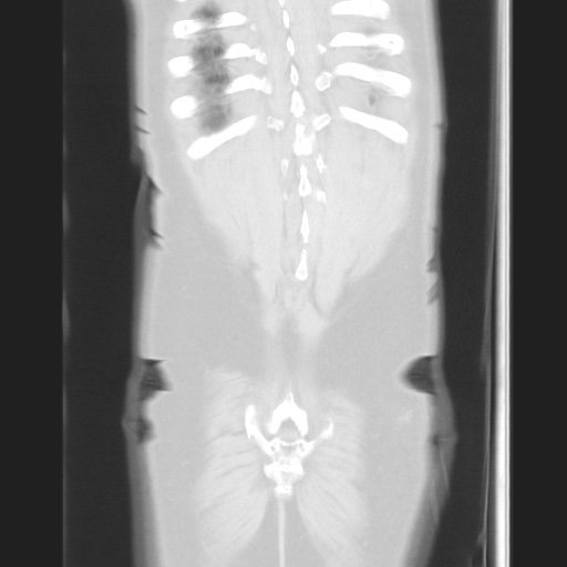 Cecal volvulus (Radiopaedia 75378-86620 Coronal lung window 121).jpg