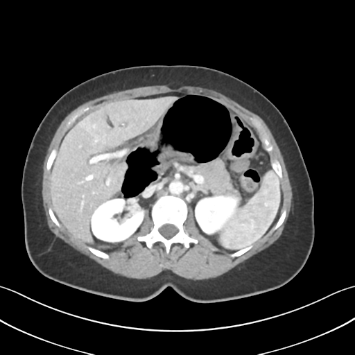 Cecum hernia through the foramen of Winslow (Radiopaedia 46634-51112 A 23).png