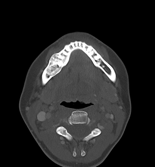 File:Cemento-ossifying fibroma (Radiopaedia 46243-50643 Axial bone window 44).png