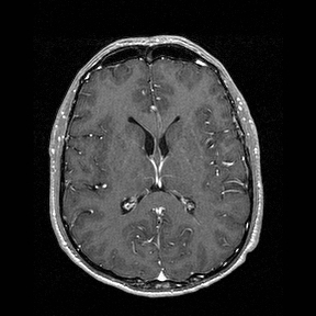 File:Central-variant posterior reversible encephalopathy syndrome (PRES) (Radiopaedia 43880-47358 Axial T1 C+ 91).jpg