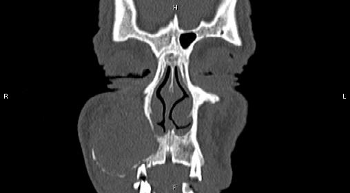 File:Central giant cell granuloma (Radiopaedia 83346-97761 Coronal bone window 5).jpg