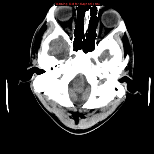 File:Central nervous system vasculitis (Radiopaedia 8410-9234 Axial non-contrast 4).jpg
