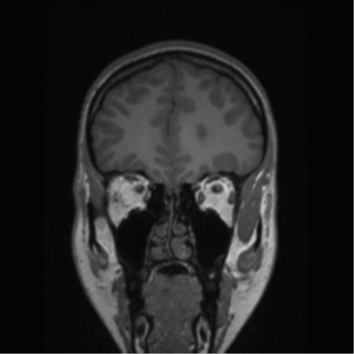 Central neurocytoma (Radiopaedia 37664-39557 Coronal T1 71).png