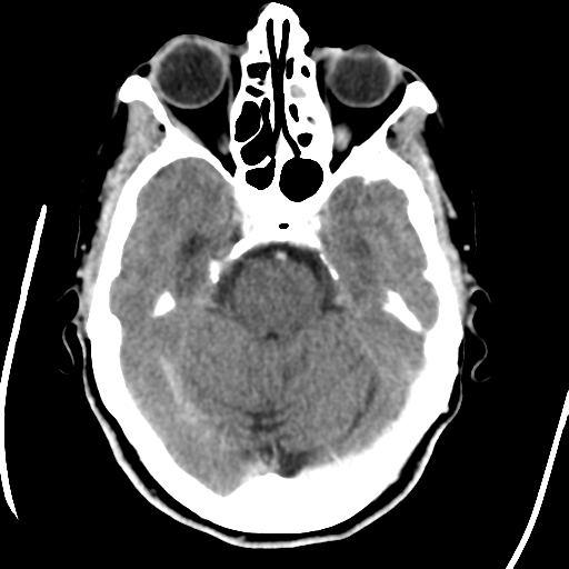 Central neurocytoma (Radiopaedia 65317-74346 Axial C+ delayed 16).png