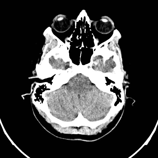 Central neurocytoma (Radiopaedia 84497-99871 Axial non-contrast 7).jpg
