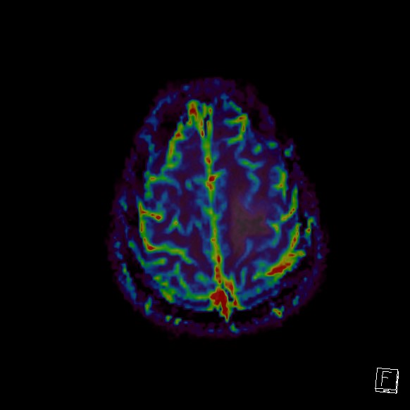 Central neurocytoma (Radiopaedia 84497-99872 Axial Perfusion 45).jpg