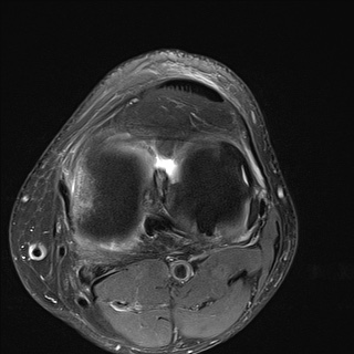File:Central osteophyte (Radiopaedia 72592-83151 Axial PD fat sat 20).jpg