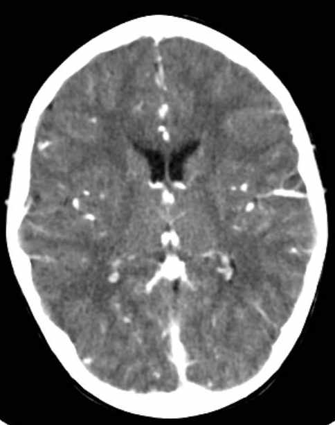 Cerebellar abscess (Radiopaedia 73727-84527 Axial C+ 46).jpg