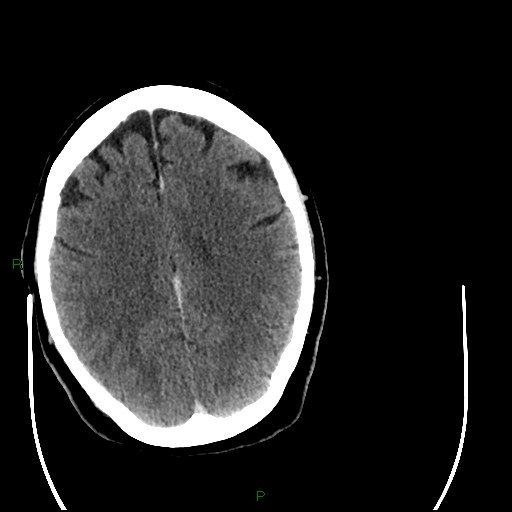 Cerebellar abscess (Radiopaedia 78135-90671 Axial C+ delayed 72).jpg