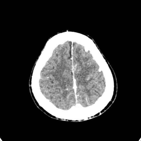 Cerebellar abscess secondary to mastoiditis (Radiopaedia 26284-26412 Axial C+ delayed 134).jpg