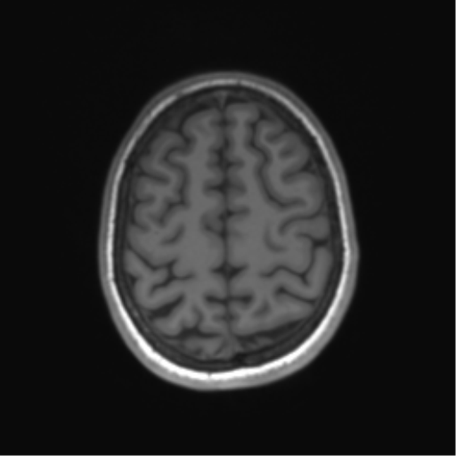 File:Cerebellar agenesis with hypoplastic pons (pontocerebellar hypoplasia) (Radiopaedia 57224-64138 Axial T1 62).png