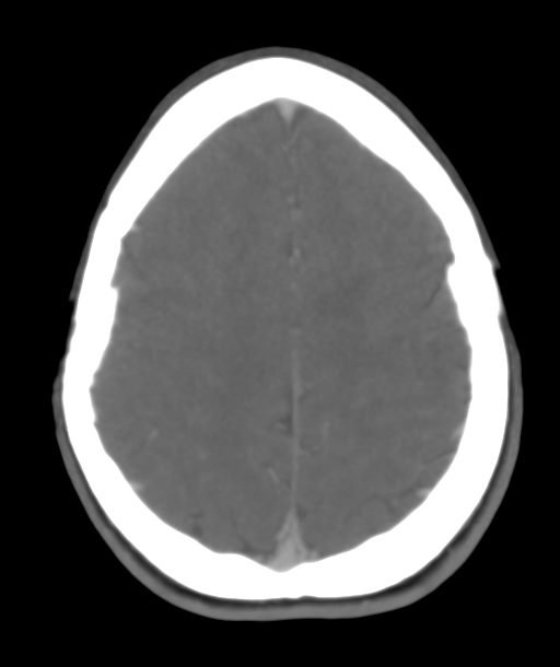 Cerebellar arteriovenous malformation- with hemorrhage (Radiopaedia 35752-37297 B 41).png
