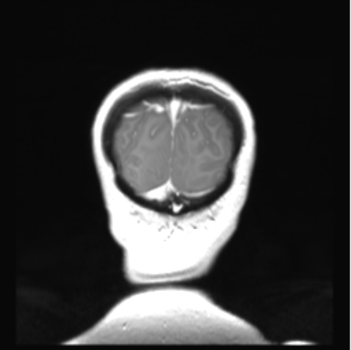 Cerebellar ependymoma complicated by post-operative subdural hematoma (Radiopaedia 83322-97736 Coronal T1 C+ 54).png