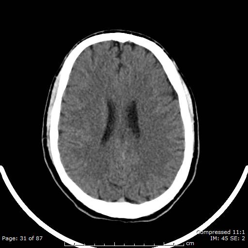 Cerebellar hemangioblastoma (Radiopaedia 52360-58258 Axial non-contrast 31).jpg
