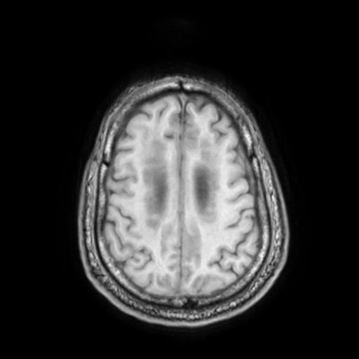File:Cerebellar hemangioblastoma (Radiopaedia 88055-104622 Axial T1 27).jpg