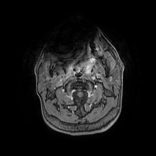 Cerebellar hemangioblastoma (Radiopaedia 88055-104622 Axial T1 C+ 3).jpg