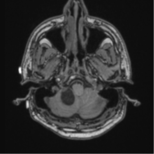 File:Cerebellar hemangioblastomas and pituitary adenoma (Radiopaedia 85490-101176 Axial T1 11).png