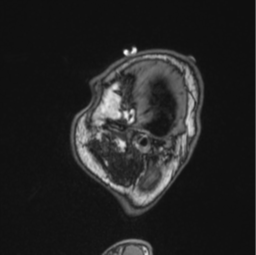 Cerebellar hemangioblastomas and pituitary adenoma (Radiopaedia 85490-101176 Sagittal T1 85).png