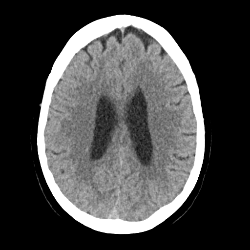 Cerebellar metastasis (Radiopaedia 54578-60812 Axial non-contrast 32).png