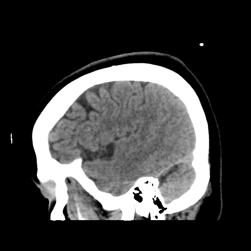 Cerebellar metastasis (cystic appearance) (Radiopaedia 41395-44258 E 15).png