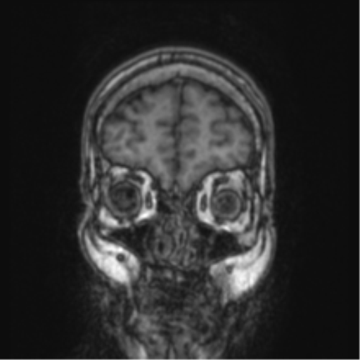 Cerebellar metastasis from lung adenocarcinoma (Radiopaedia 86690-102829 Coronal T1 86).png