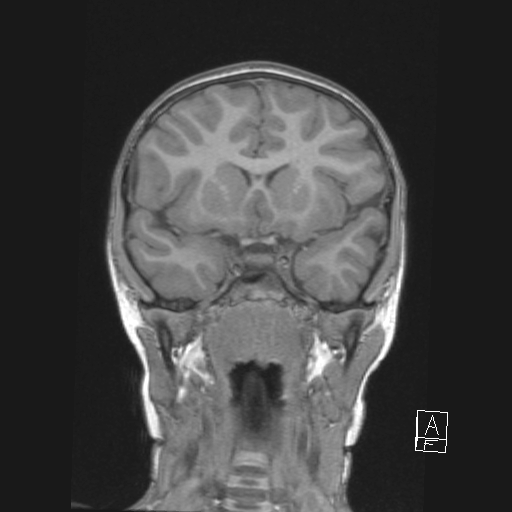Cerebellar stroke (Radiopaedia 32202-33150 Coronal T1 23).png