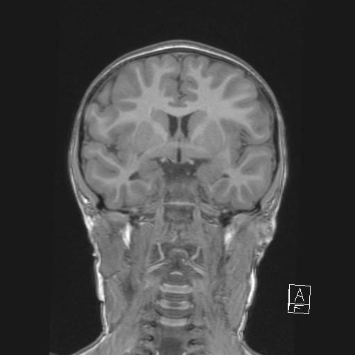 File:Cerebellar stroke (Radiopaedia 32202-33150 Coronal T1 27).png