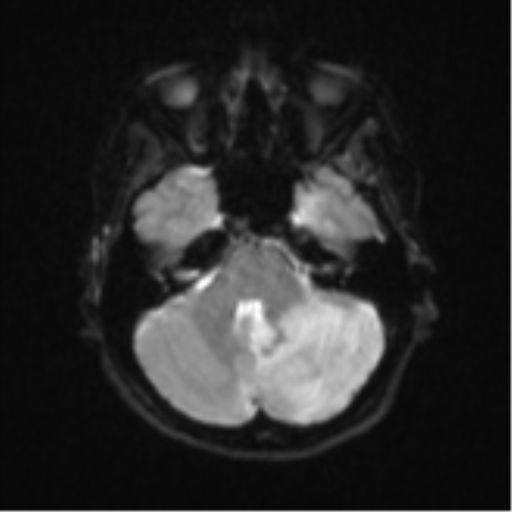 Cerebellar tuberculomas (Radiopaedia 46939-51472 Axial DWI 8).png