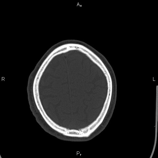 Cerebellopontine angle arachnoid cyst (Radiopaedia 85149-100704 Axial bone window 44).jpg
