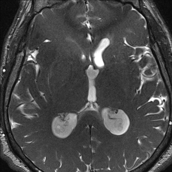 Cerebellopontine angle meningioma (Radiopaedia 24459-24764 I 57).jpg