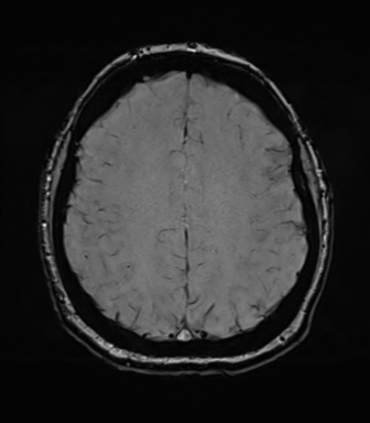 Cerebellopontine angle meningioma (Radiopaedia 48434-53348 Axial SWI 66).png