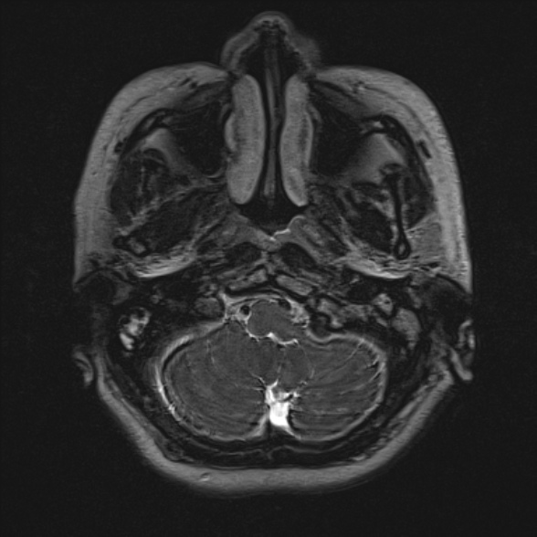 Cerebellopontine angle meningioma (Radiopaedia 53561-59591 Axial 3D volume T2 23).jpg