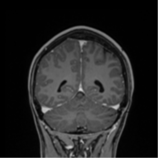 File:Cerebral abscess (Radiopaedia 60342-68009 H 10).png