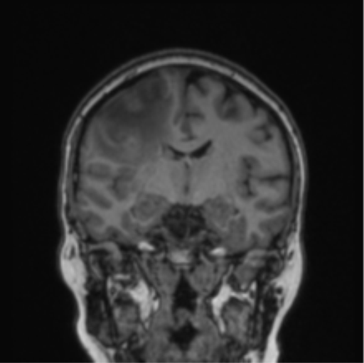 File:Cerebral abscess from pulmonary arteriovenous malformation (Radiopaedia 86275-102291 Coronal T1 49).png