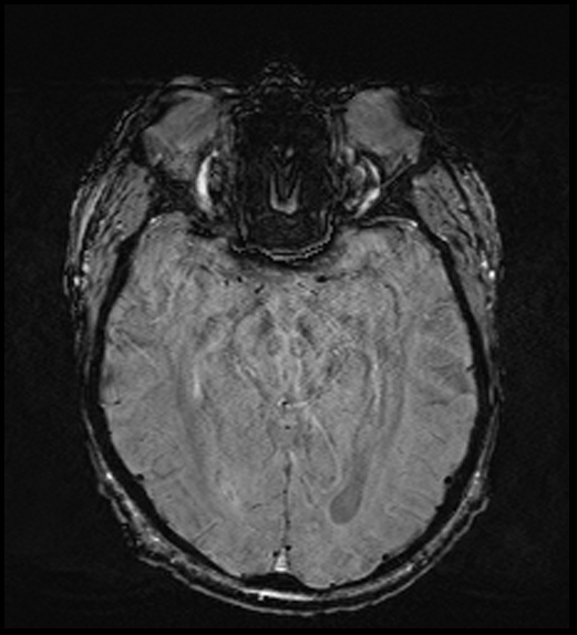 Cerebral abscess with ventriculitis (Radiopaedia 78965-91878 Axial SWI 24).jpg