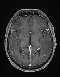 Cerebral amyloid angiopathy-related inflammation (Radiopaedia 58270-65377 Axial T1 C+ fat sat 68).jpg