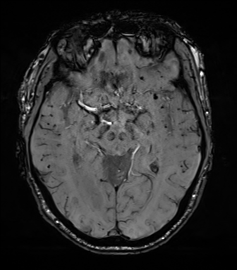 File:Cerebral amyloid angiopathy (Radiopaedia 46082-50433 Axial SWI 36).png