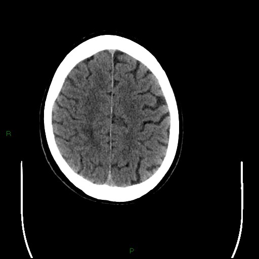 File:Cerebral amyloid angiopathy (Radiopaedia 77506-89665 Axial non-contrast 84).jpg