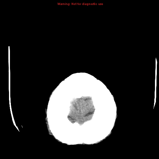 File:Cerebral and orbital tuberculomas (Radiopaedia 13308-13310 Axial non-contrast 27).jpg