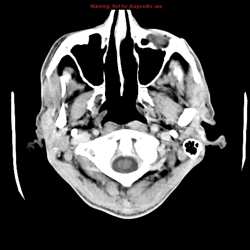 File:Cerebral and orbital tuberculomas (Radiopaedia 13308-13310 B 2).jpg
