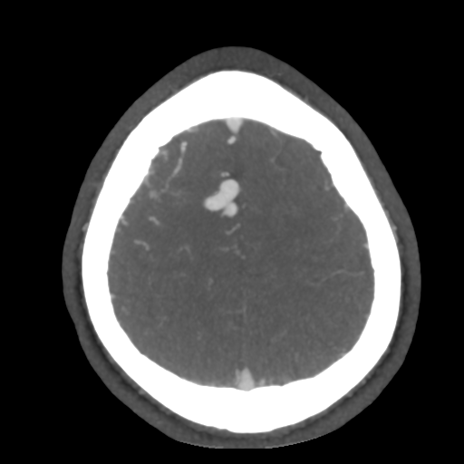 Cerebral arteriovenous malformation (Radiopaedia 39259-41505 AX CEREBRAL CTA 48).png