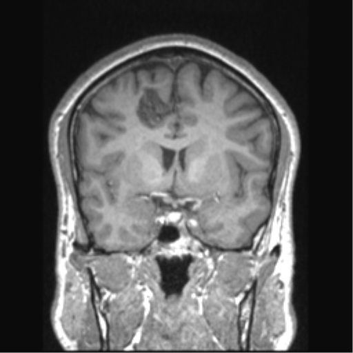 File:Cerebral arteriovenous malformation (Radiopaedia 39259-41506 Coronal T1 56).png