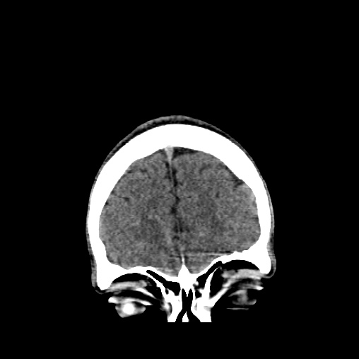 Cerebral arteriovenous malformation (Radiopaedia 61964-70028 Coronal non-contrast 9).jpg