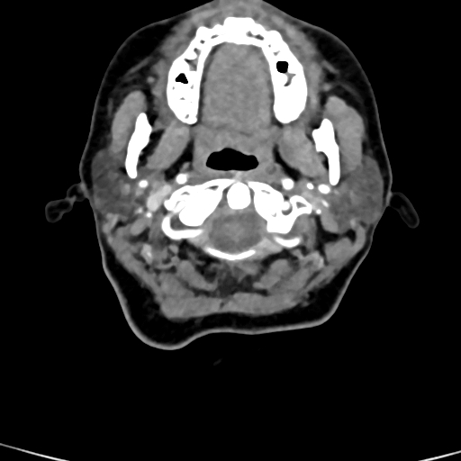 Cerebral arteriovenous malformation (Radiopaedia 73830-84645 B 98).jpg