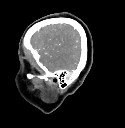 Cerebral arteriovenous malformation (Radiopaedia 73830-84645 D 13).jpg