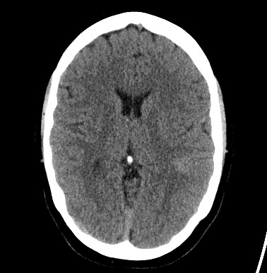 File:Cerebral arteriovenous malformation (Radiopaedia 74411-85744 Axial non-contrast 17).jpg