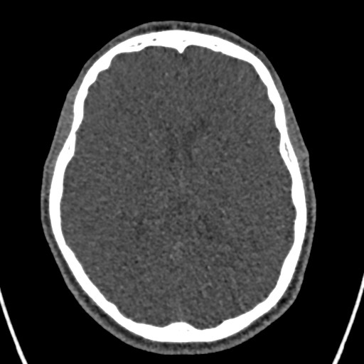 Cerebral arteriovenous malformation (Radiopaedia 78188-90746 Axial non-contrast 101).jpg