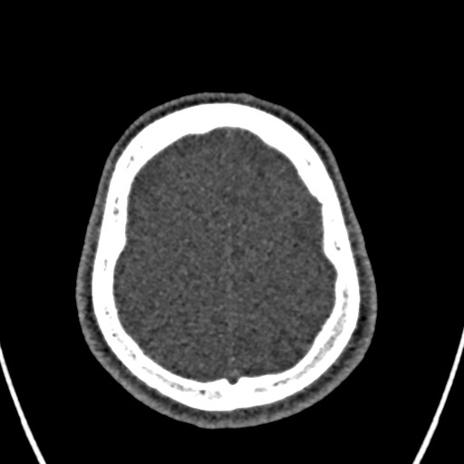 Cerebral arteriovenous malformation (Radiopaedia 78188-90746 Axial non-contrast 151).jpg