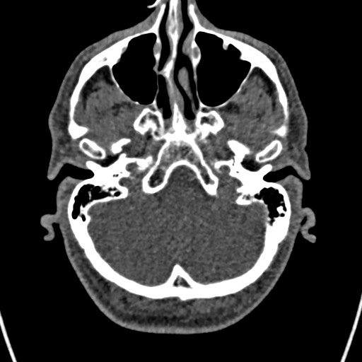 File:Cerebral arteriovenous malformation (Radiopaedia 78188-90746 Axial non-contrast 31).jpg
